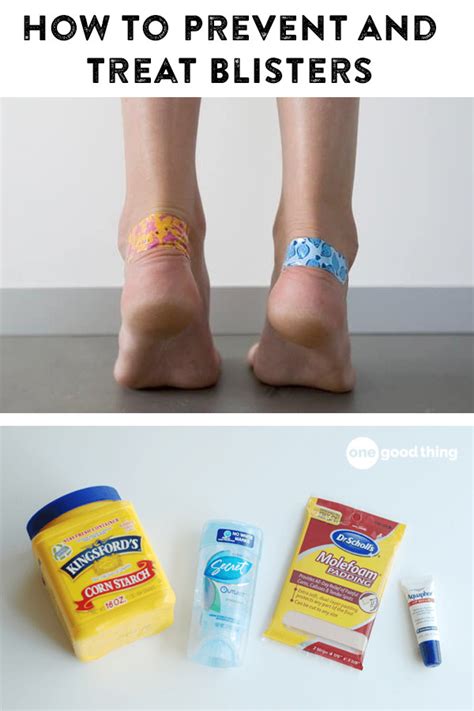How To Prevent And Treat Blisters