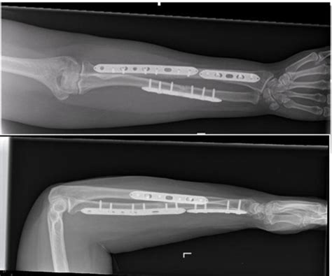 Left Forearm Open Reduction And Internal Fixation Of Radius And Ulna At My Xxx Hot Girl