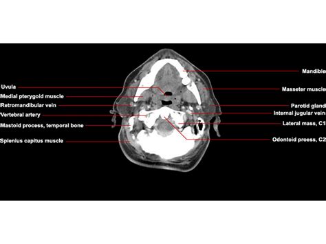 Ct Neck Axial Anatomy Radiologypicscom