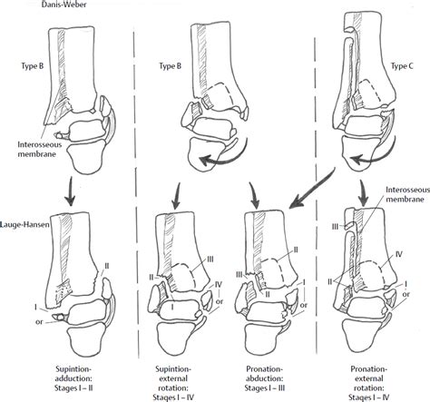 Ankle Fracture Types