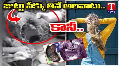 Telangana Doctors Remove 2kg Hair From Womans Stomach In Nirmal