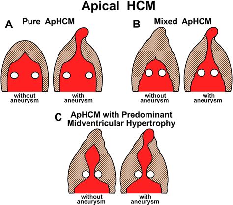 Apical Hypertrophic Cardiomyopathy Present Status International