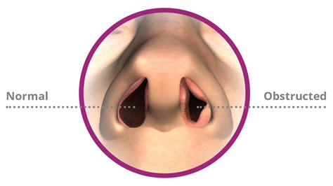 New Non Invasive Treatment For Nasal Airway Obstruction Stuffy Nose — Ent And Allergy Inc