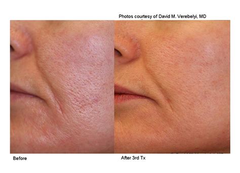 How to minimize your pores, according to dermatologists. Shrink Large Pores - T. Douglas Gurley MD
