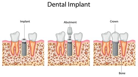Dental Implants Procedure Step By Step Welcome To Dr Arman Torbatis Dental Blog Los