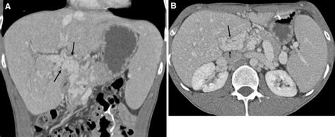 Cavernous Transformation Of The Portal Vein Ct Appearance A B Axial