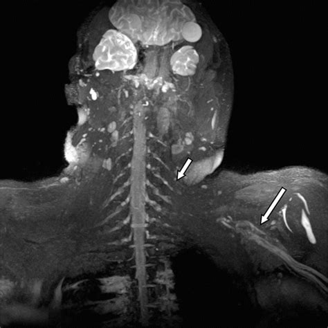 Anatomy Imaging And Pathologic Conditions Of The Brachial Plexus