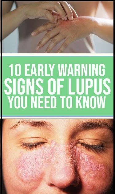 10 Early Warning Signs Of Lupus You Need To Know Wellness Days