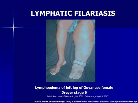 Ppt Lymphatic Filariasis A Major Public Health Challenge In The 21st