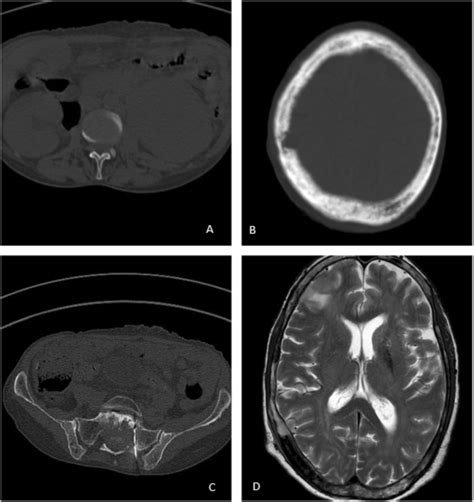 Axial Non Contrast Ct At The Level Of Kidneys Showing Bilaterally
