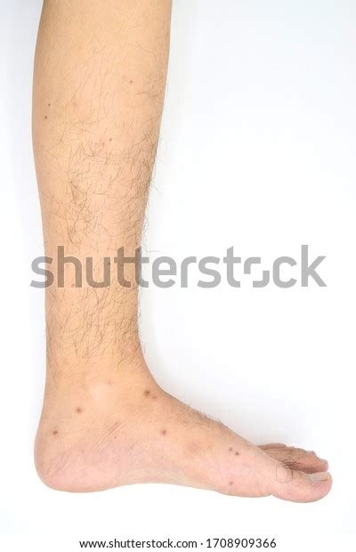 Black Spots Old Scars Mosquito Bite Stock Photo Edit Now 1708909366