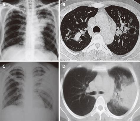 Chest Radiographic And Computed Tomographic Manifestations In Allergic