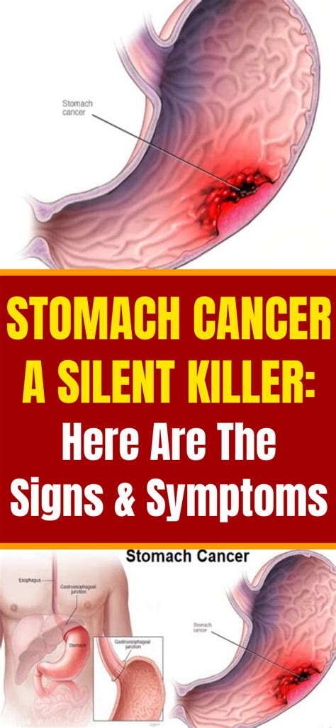 Seek medical attention if you have. Wellness Tips: Stomach Cancer A Silent Killer - Most ...