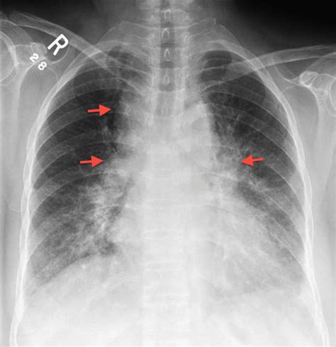 Garland Triad A Chest Radiograph Sign Of Sarcoidosis It Refers To A
