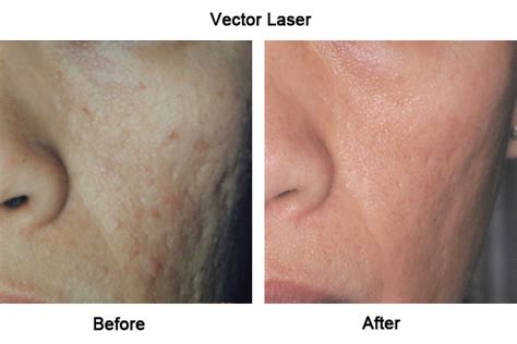 Laser Skin Toning Revlite Si
