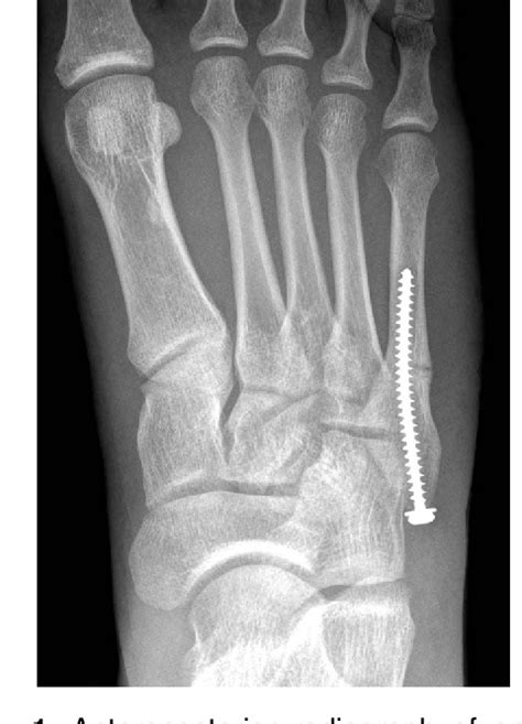 Figure 1 From Plate Fixation Of Proximal Fifth Metatarsal Fracture