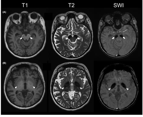 Mri Findings In Bpan Brain Mri Of The Norwegian Patient At The Age Of