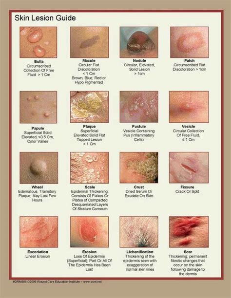 Skin Lesion Guide Atlas Diagnosis Dermatology Skin Grepmed