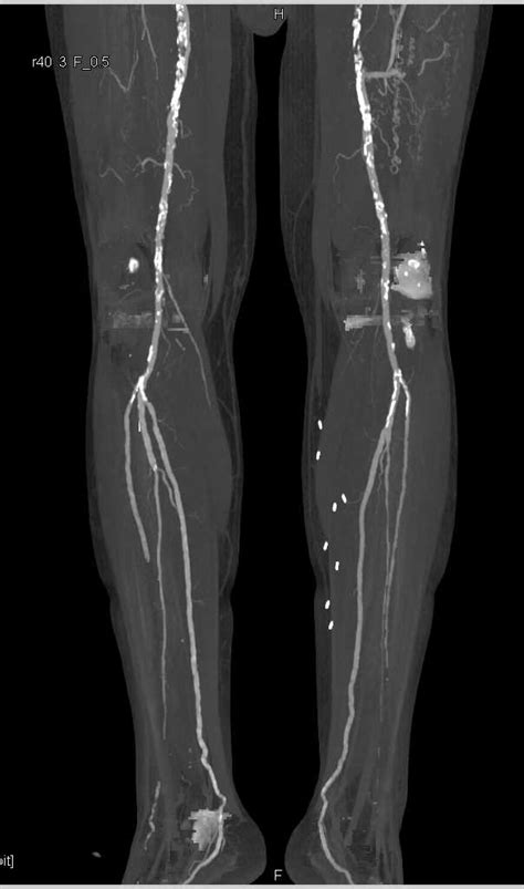 Occlusion Left Superficial Femoral Artery Sfa With Collaterals