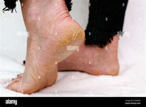 Dry And Cracked Soles Of Feet Womans Feet With Dry Heels Cracked Skin