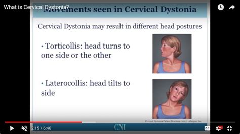 what is cervical dystonia
