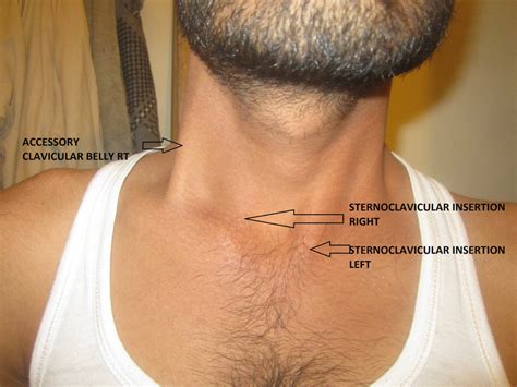 A Right Accessory Clavicular Sternocleidomastoid Inserting At