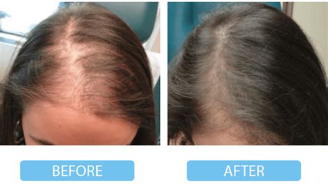 Prp Hair Loss Treatment In Toronto Vita Cosmetic And Laser Clinic
