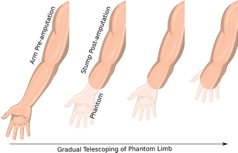 Pdf An Introduction To Phantom Limb Pain Semantic Scholar