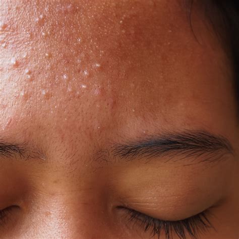 How To Get Rid Of Pimples On Forehead 11 Best Tips Juicy Chemistry
