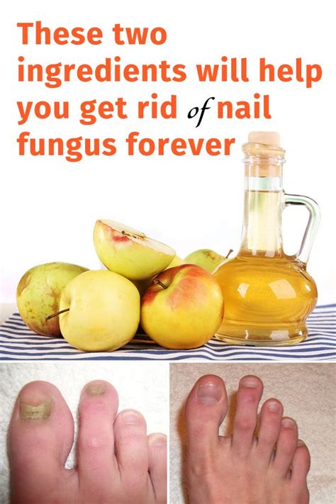 These Two Ingredients Will Help You Get Rid Of Nail Fungus Forever