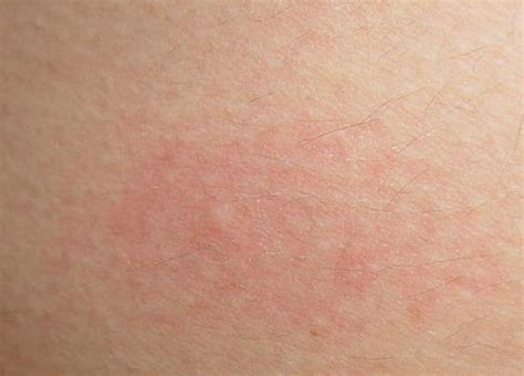 Skin Rashes Pictures