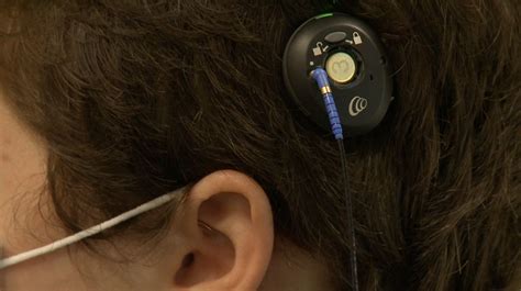 First Of Its Kind Cochlear Implant Helps Ketnucky Teen
