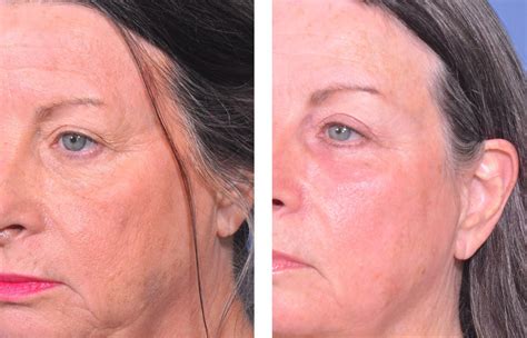 Dr Fedok Laser And Energy Device Treatment Patient 3 Results