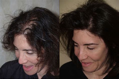 Hair Transplants For Women Photos Miami Fl Patient58205