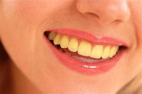 Causes Of Yellow Teeth Acharya Dental