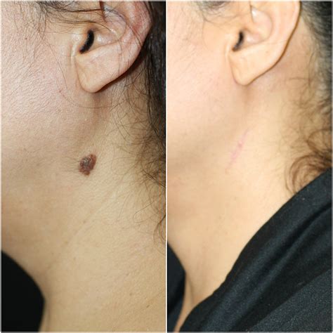 Mole Removal Photos