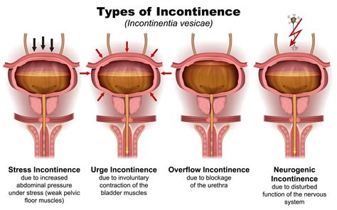 Urinary Incontinence Is Nothing To Be Embarrassed About Ms Urology