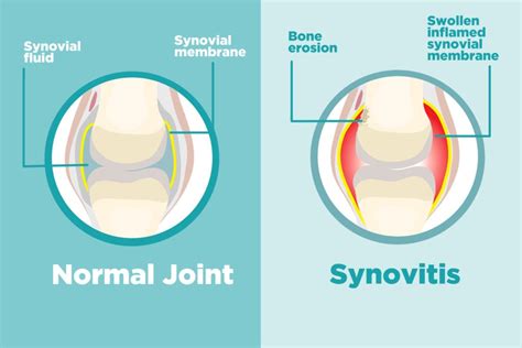 What Is Synovitis And How Does It Affect Arthritis Creakyjoints