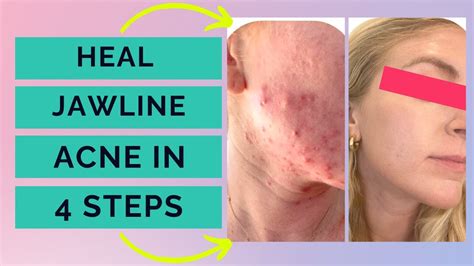 Jawline Acne 4 Steps To Clear Cystic Acne On Your Jawline Naturally