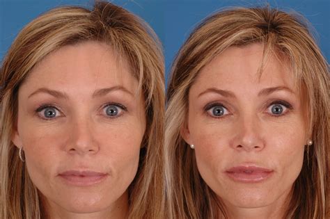 Facial Fillers Before And After Photos Dr Bassichis