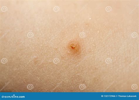 Close Up Of Molluscum Contagiosum Also Called Water Wart Stock Photo
