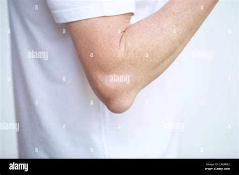 Swelling Associated With Bursitis Of The Elbow Stock Photo Alamy