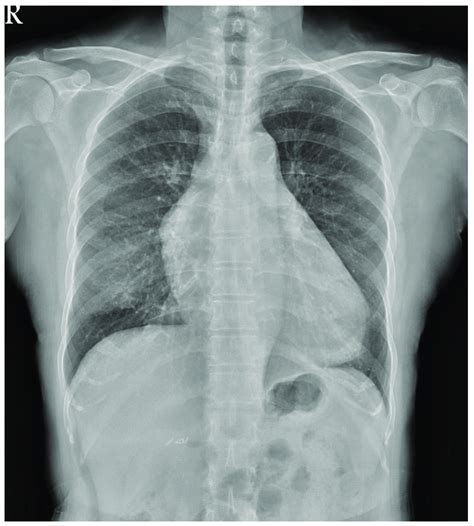 Chest Radiography Revealed Increased Soft Tissue Opacity Over The
