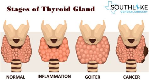 Need To Know Before Go For Thyroid Surgery Southlake General Surgery