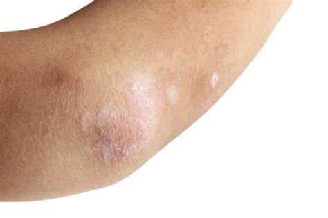 Home Remedies For Dry Itchy Skin On Elbows