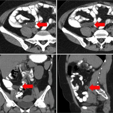 Neuroendocrine Tumor Classic Carcinoid Of The Appendix Axial