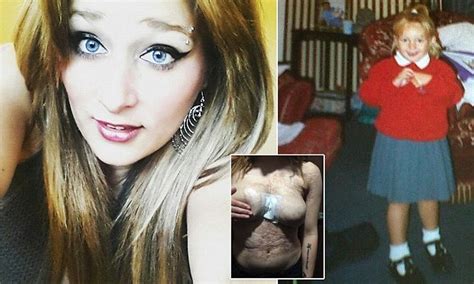 Ashleigh Lovric Has Deformed Breasts After Turning Into A Human Fireball