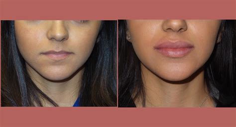 Juvederm In Oklahoma City Premier Plastic Surgery And Aesthetics En