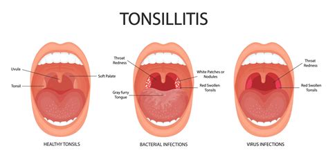 Angina Pharyngitis And Tonsillitis Tonsillitis Bacterial And Viral
