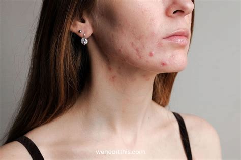 Fungal Acne Vs Closed Comedones Are They Different